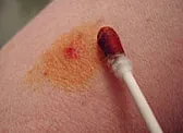 Treatment of minor wounds | &laquo; previous thread